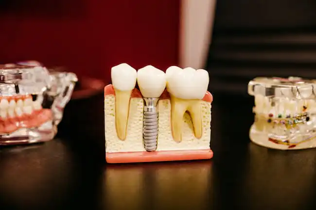 dental implant tooth dentist 2