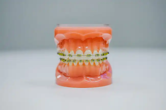dental braces 1 1